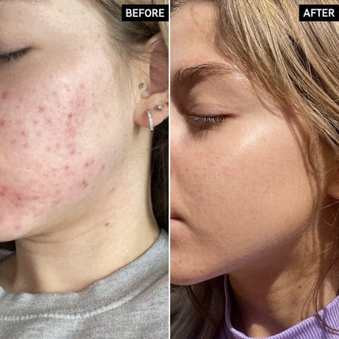The Ordinary Niacinamide 10% + Zinc 1% Serum